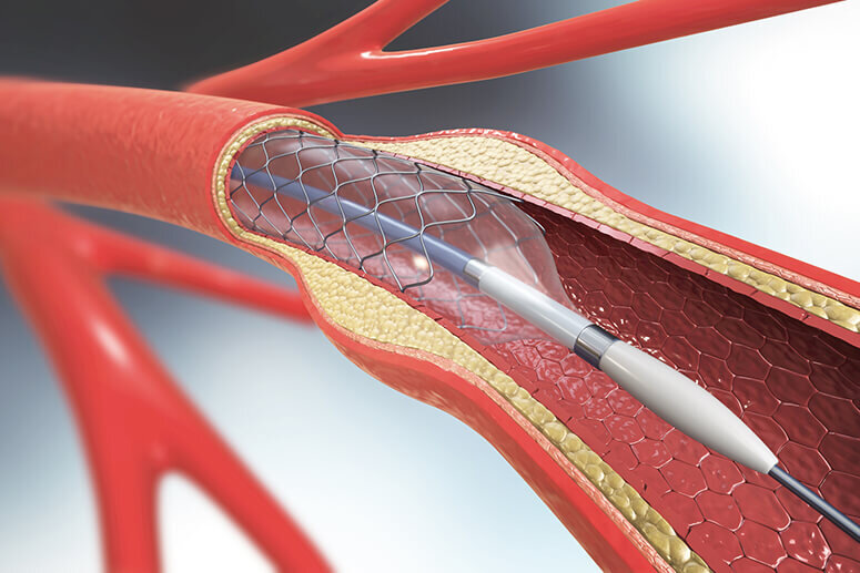 stent angioplasty repair minimally invasive treatment for PAD PVD CAD