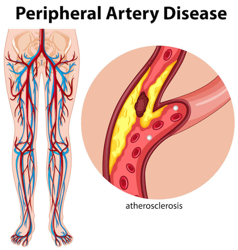 what is peripheral artery disease fatty plaque narrows arteries