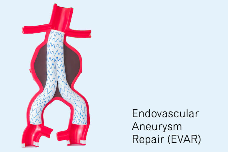 Aneurysm Repaired With Minimally Invasive EVAR Stent Graft Bypass Fix