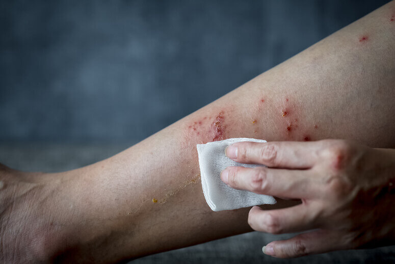 varicose veins leg injury skin infection eczema skin ulcers bleeding