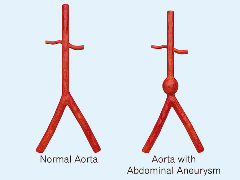 normal aorta artery vs aorta abdominal aneurysm triple a comparison